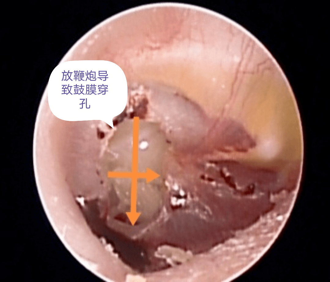 尽管在许多城市明令禁止燃放鞭炮,但在农村地区这种习俗仍然存在,当