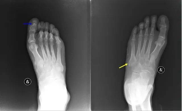 右图:第1趾远节趾骨基底部细小骨折左图:第1指近节指骨基底部细小骨折