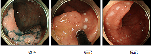 灵一技术我院消化内科顺利完成首例肠镜下肠粘膜剥离术