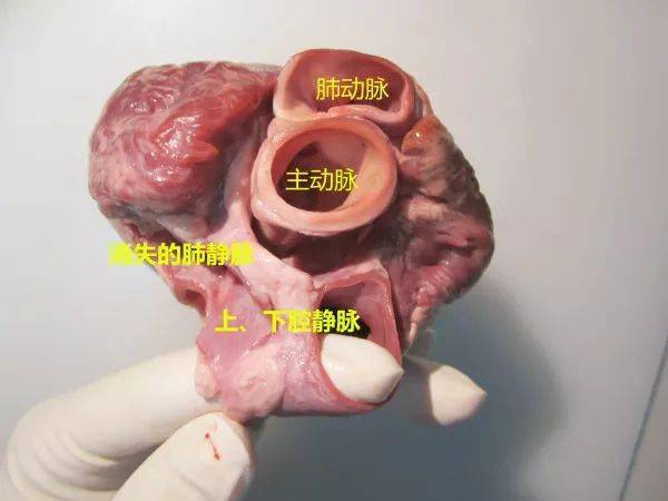 身為一名法醫,我來實際解剖一顆心臟_冠狀動脈