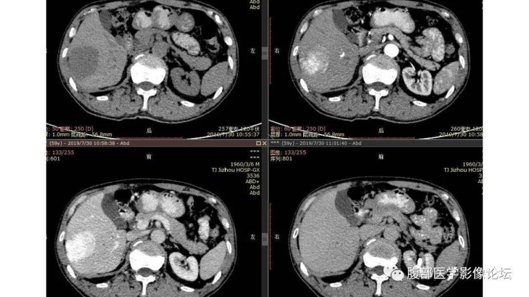 肝血管瘤影像图片