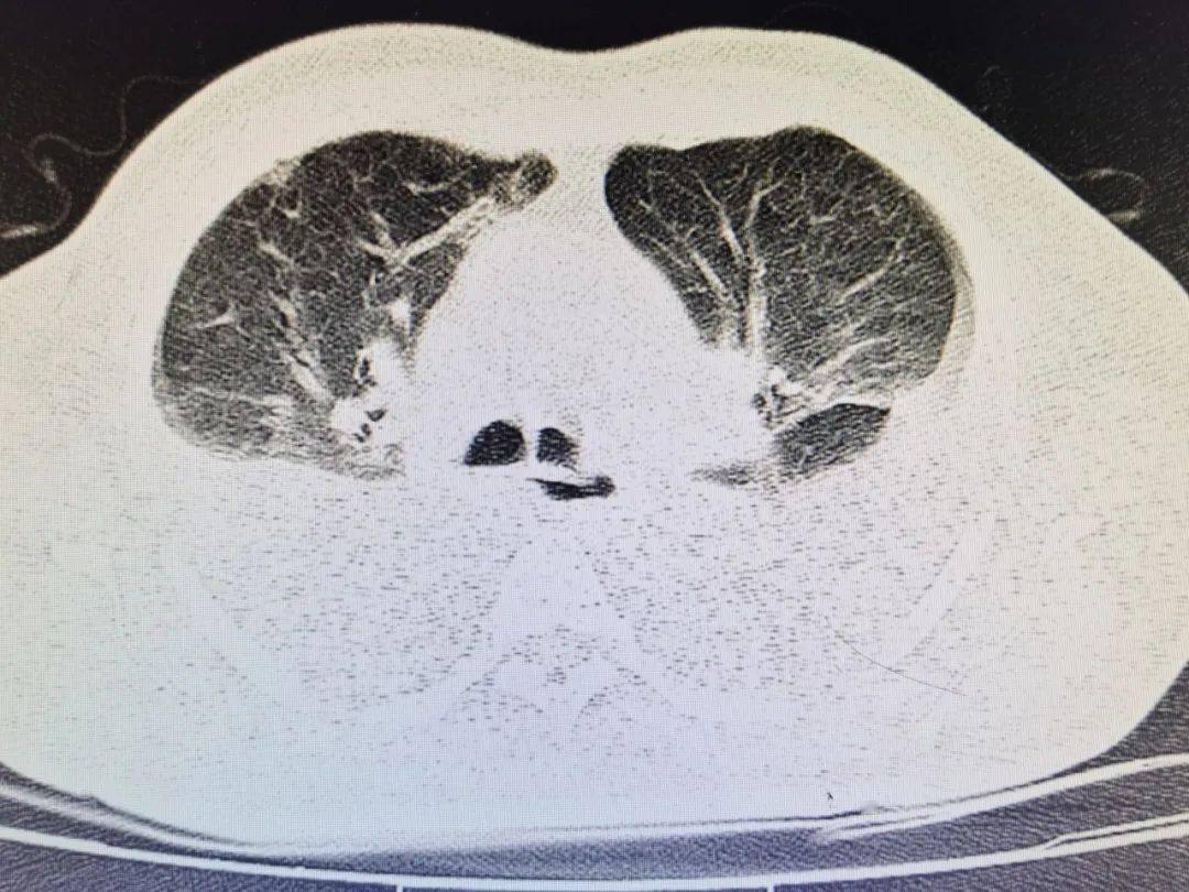 肺部积水ct图片图片
