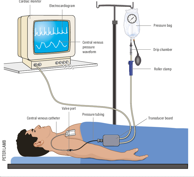 cvp-cvp