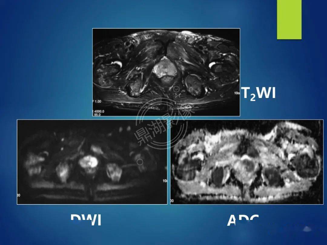 磁共振前列腺图像解析图片