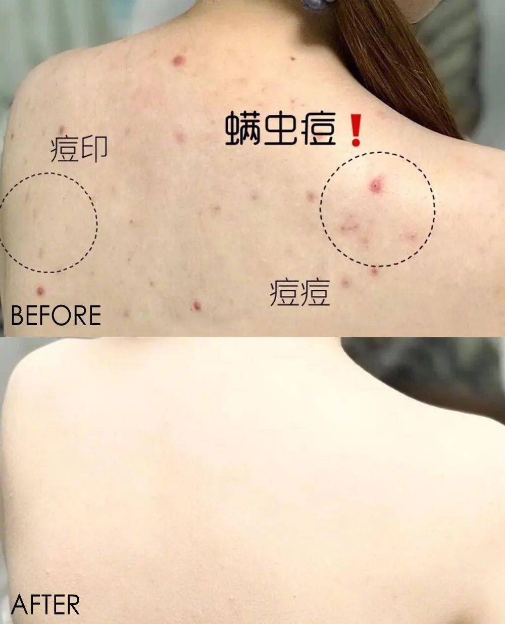 头皮上更不会又痒又油了不仅皮肤不再长螨虫痘过敏打喷嚏的情况都减少