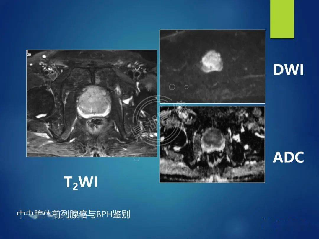 前列腺癌的磁共振成像诊断