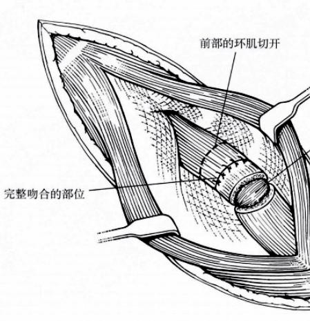 一例猫食道狭窄手术治疗