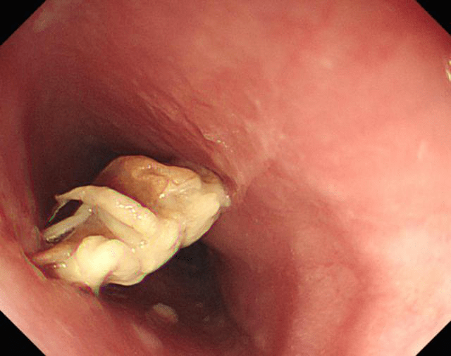 惠州女子被整只螃蟹横卡食道……_异物