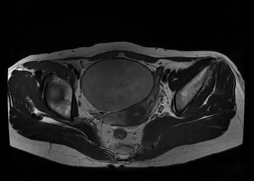 经典病例遇到卵巢纤维瘤你会鉴别吗