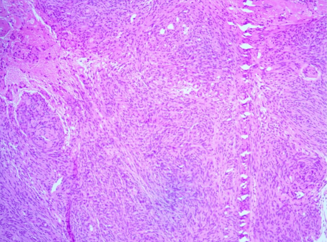 病例分享累及颅骨及矢状窦的脑膜瘤simpsoni级切除一