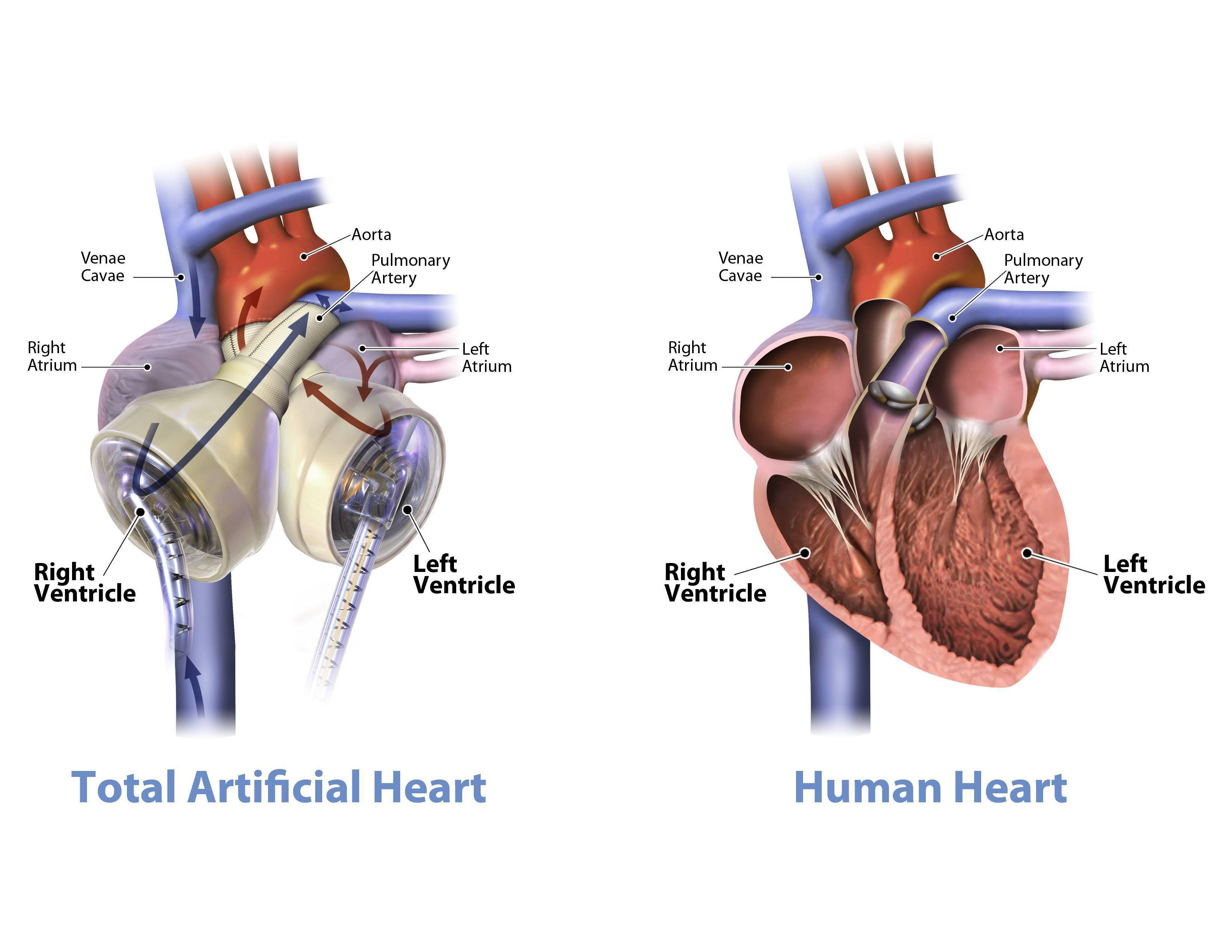 人工心脏是什么样子的图片