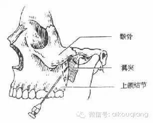 使該神經分佈區獲得麻醉效果,稱為阻滯麻醉,適用於骨質較緻密的下頜骨