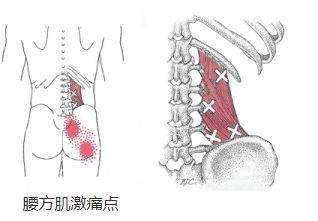 腰痛的重要原因腰方肌激痛点