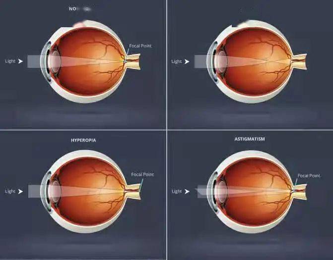 屈光不正看到的图像图片
