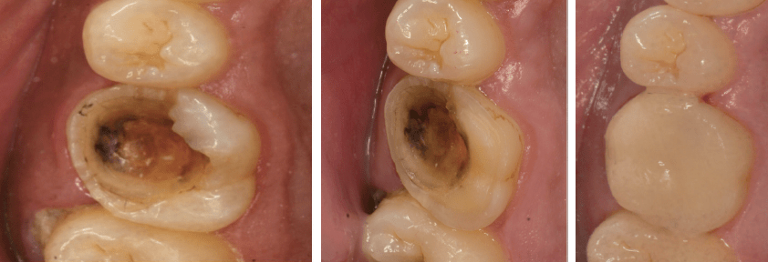 临床先锋粘接修复的失败和提示姜婷教授