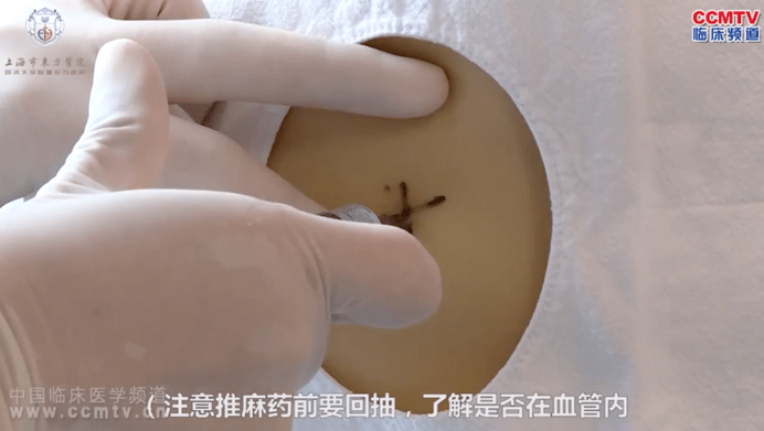 六,抽液过程抽液量的多少,抽液速度及抽出液体的色,质,包括患者的状态