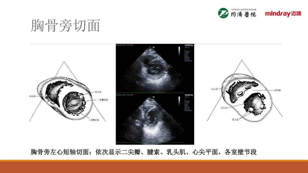 武汉同济医院麻醉科围术期经胸超声心动图tte