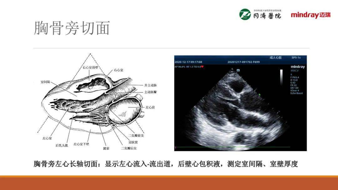武汉同济医院麻醉科围术期经胸超声心动图tte