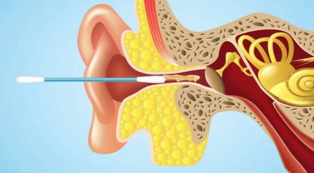 被大家嫌弃的耳屎是人类正常的外耳道皮肤及腺体的分泌物(医学名:耵聍