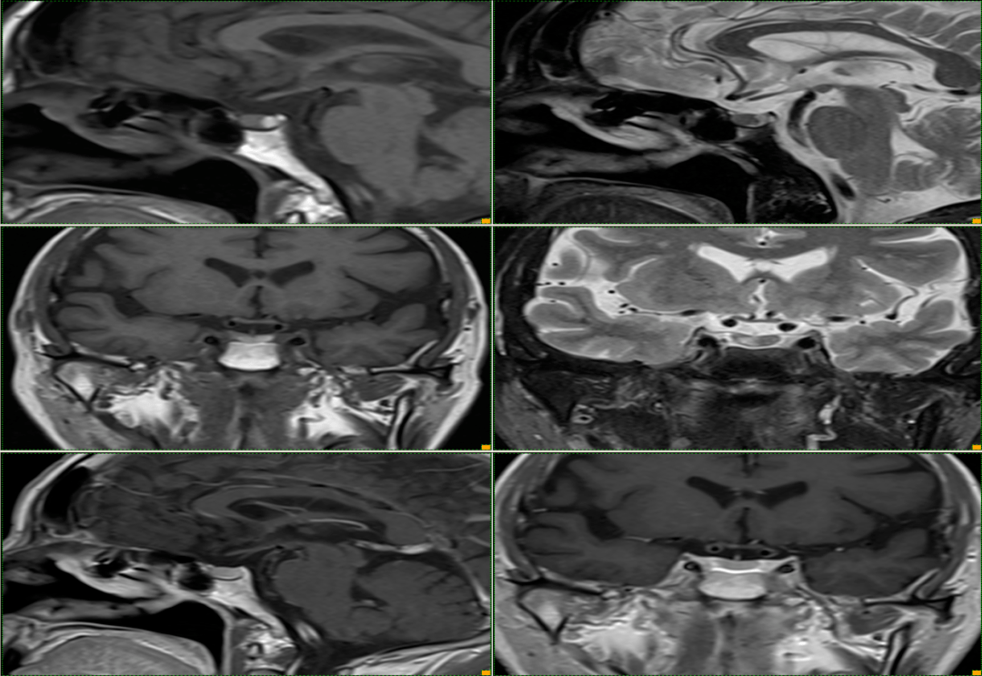 t1wi 高信号的神经垂体前方case 5:m/52y矢状位 t2wi 示:高信号囊肿和