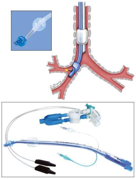 左双腔支气管导管图片图片