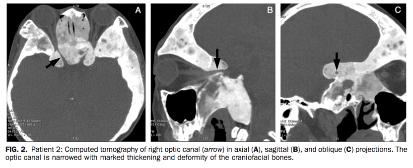关注不同病因的鞍区占位性病变对视交叉功能的损害