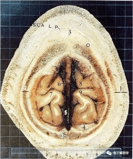 经典大体颅脑断层解剖图——横断面