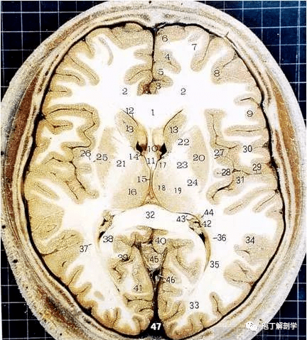 脑干断层解剖图图片