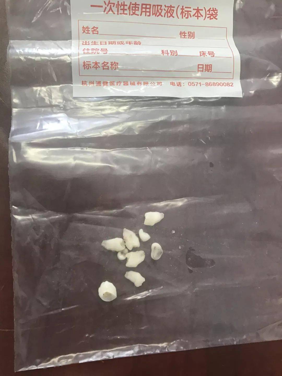 小刚颅内包块里那些一颗颗的物质,竟然是一颗颗牙齿,一共有9颗!