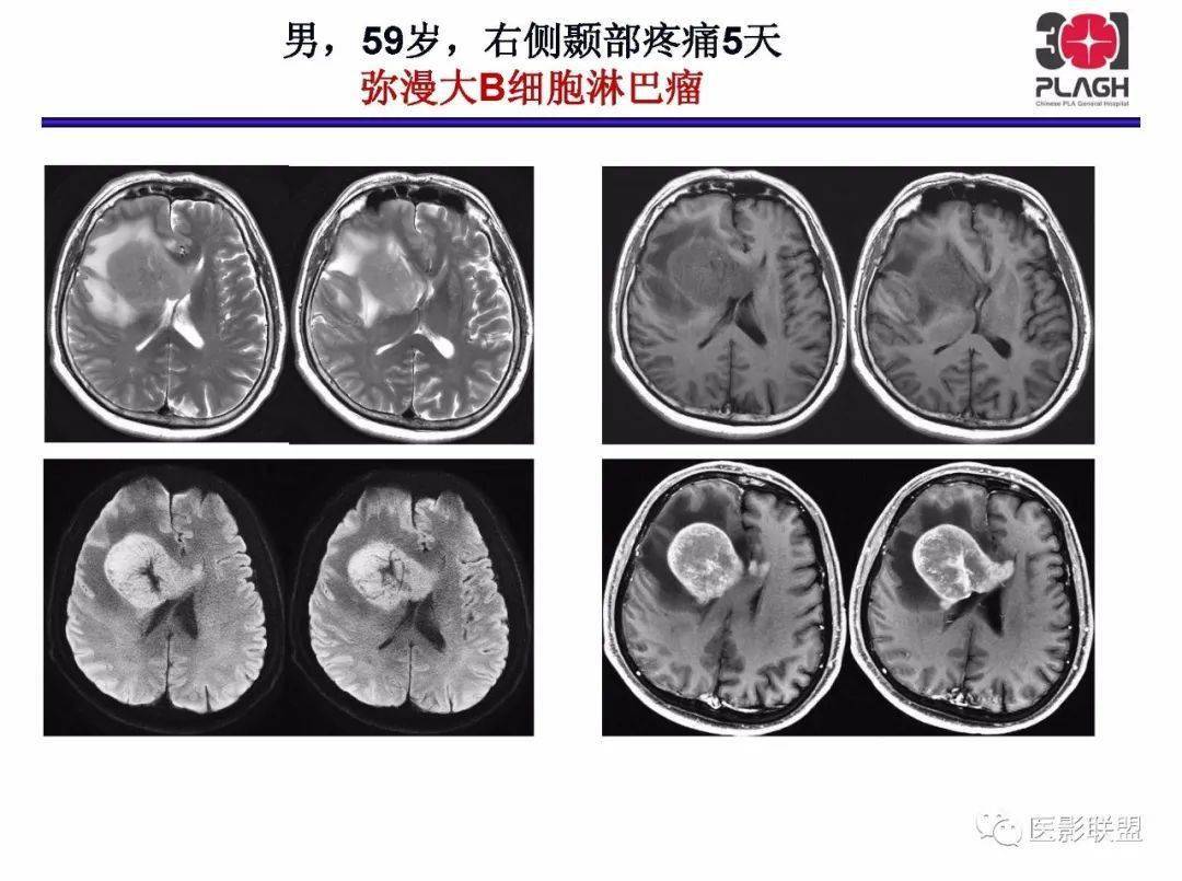 不典型原发中枢神经系统淋巴瘤影像诊断思路