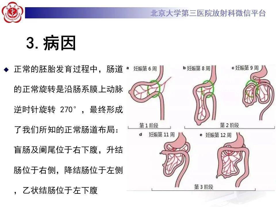 腹部肠旋转不良im影像表现