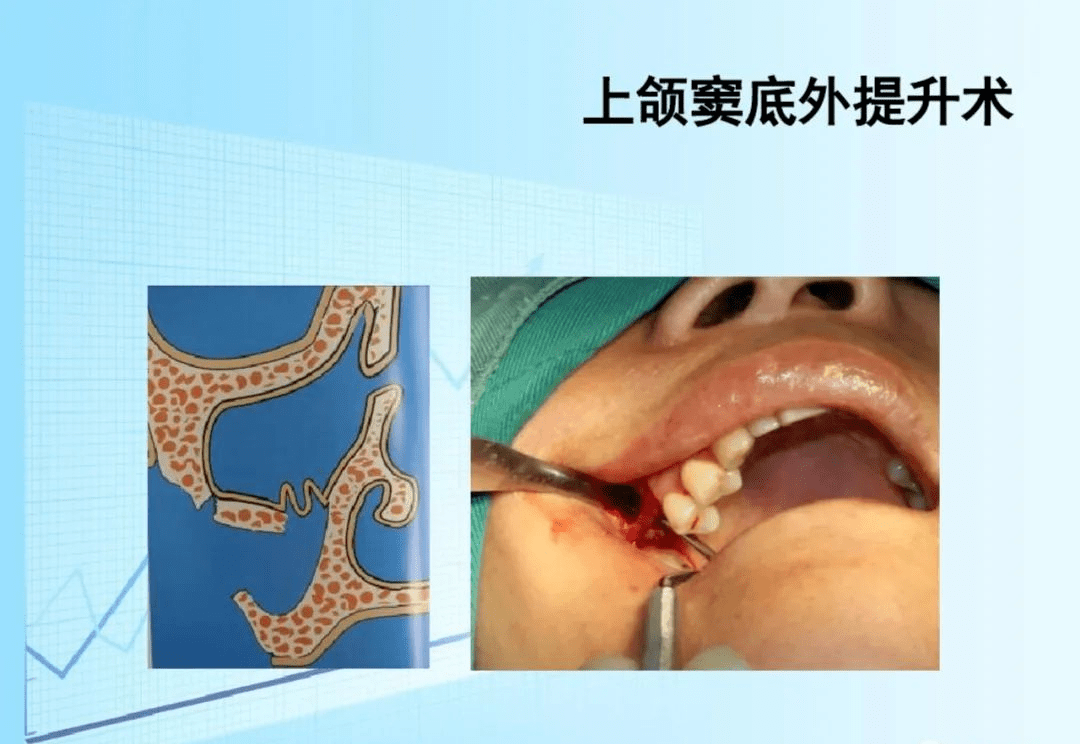 种牙上颌窦提升全过程图片