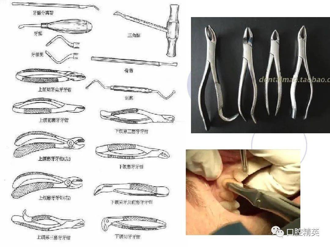 口腔科常用器械圖譜結構及功能介紹
