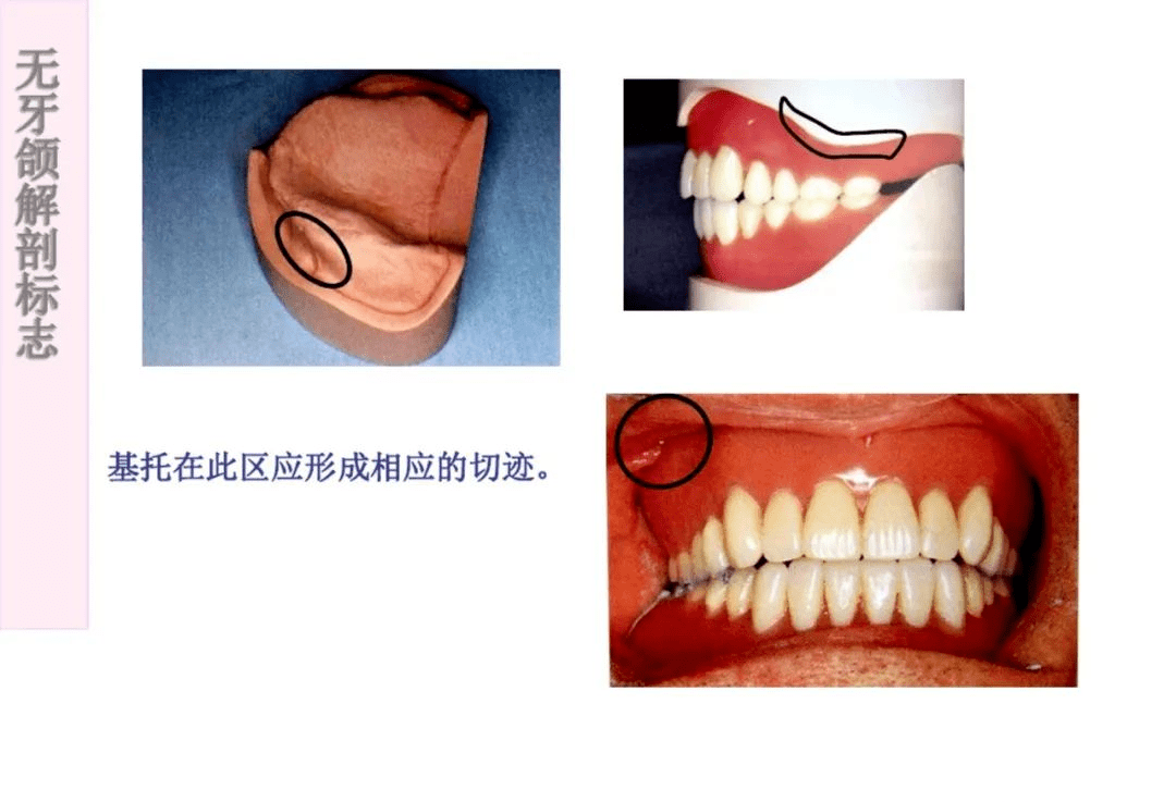 【乾貨】無牙頜解剖標誌_違規