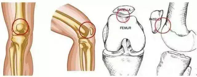 膝關節常見損傷特徵總結_髕骨