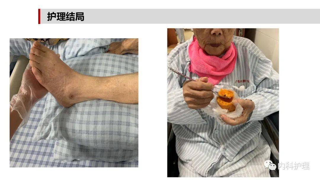 一例下肢深静脉血栓形成行导管接触性溶栓的个案护理