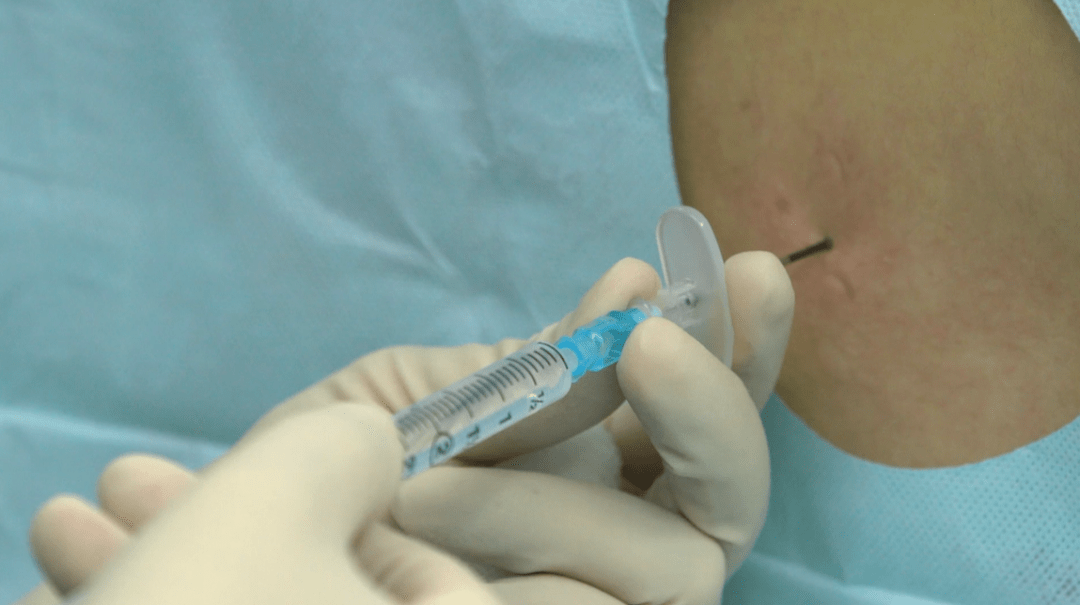 北京协和医院麻醉科 | 椎管内麻醉 / 镇痛的实施规范