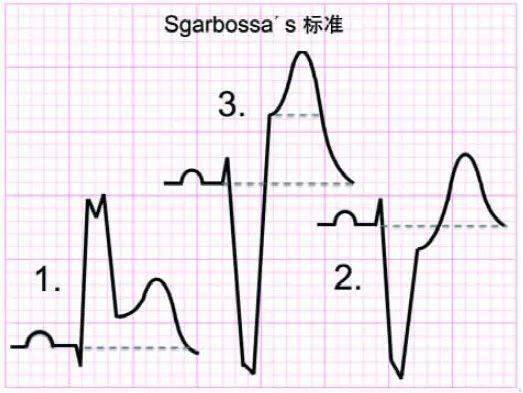 左束支阻滯合併急性心肌梗死的心電圖改變