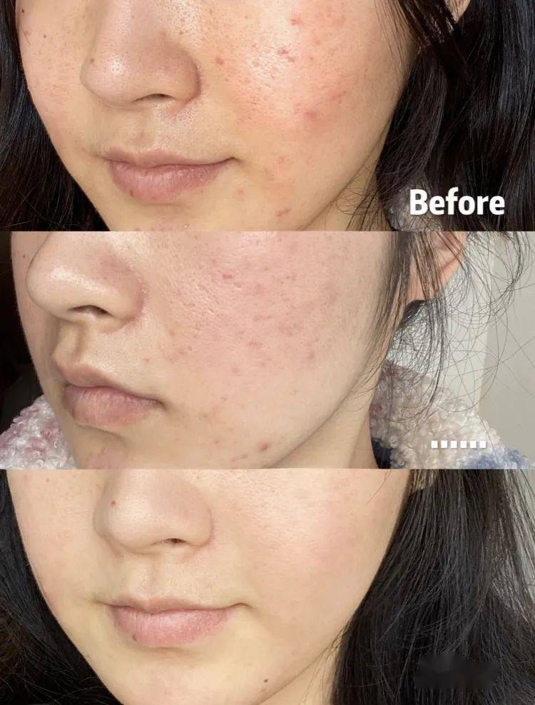 到三天,就能彻底消灭痘痘在脸上onewoo植萃草本祛痘凝胶不过自从我有