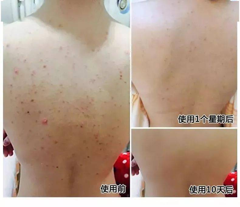 如何杀死螨虫细菌 07e8b6e3e4454c9eaf1b48fafd83774b.jpeg