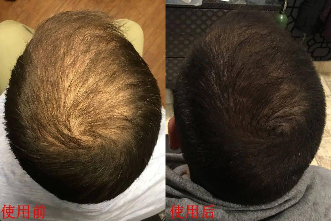 头皮发痒脱发是什么原因 7313cfb8a2954137993143a4b1fc3557.jpeg