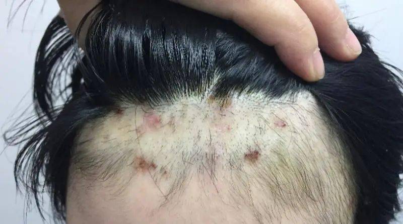 湖南丨害怕11岁女孩拔自己头发致头皮发炎医生一种精神性疾病