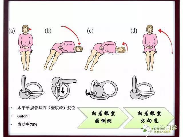 手把手教你診治良性陣發性位置性眩暈含最全的耳石症復位方法