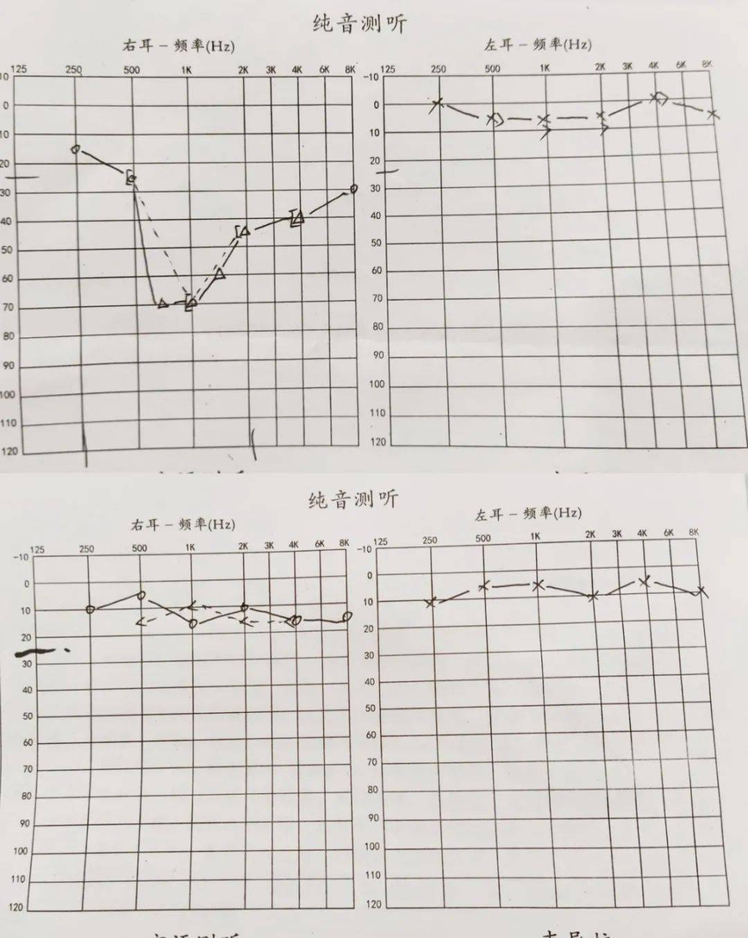 (治疗前后纯音测听对比)临床研究显示,突聋的治疗时间越早越好,发作48