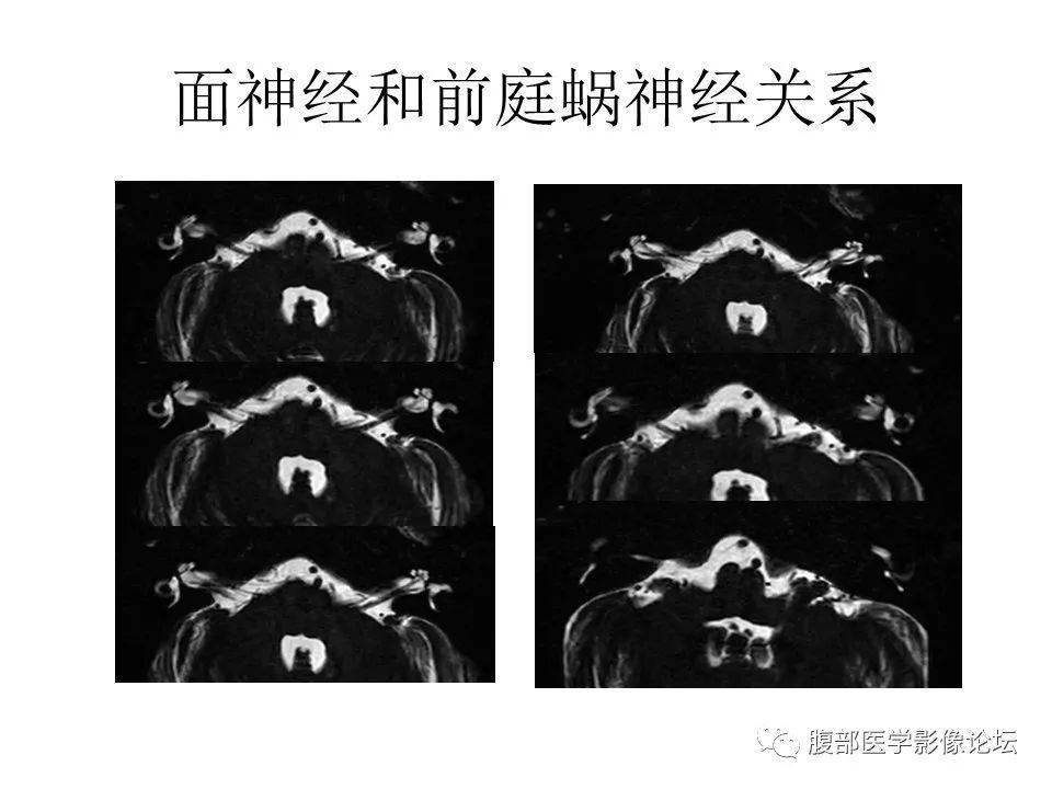 原创丨颅骨颅底系列之面面俱到细微处面神经