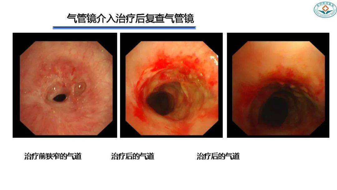 良性中央气道狭窄的介入治疗_气管
