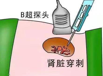 徐水中医院我院糖尿病肾病科开展肾穿刺活检术