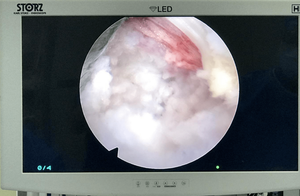 银屑病痛风高血压200斤小伙腰腿痛走不了路脊柱专家一招就搞定
