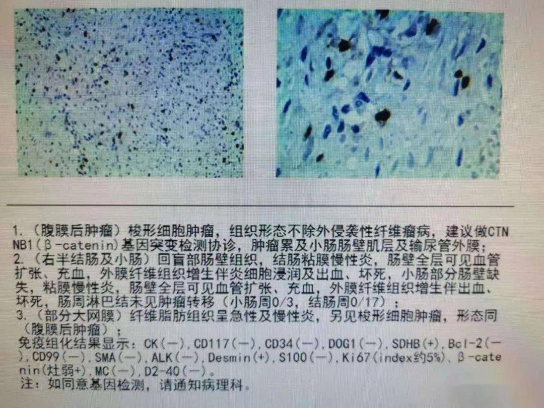 腹膜后侵袭性纤维瘤病早期发现仍然是治疗的关键