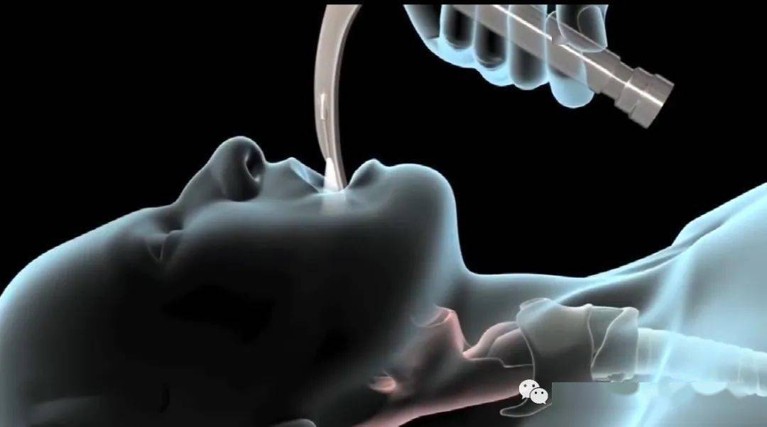 气管插管的护理配合会了吗要做到永远快医生一步